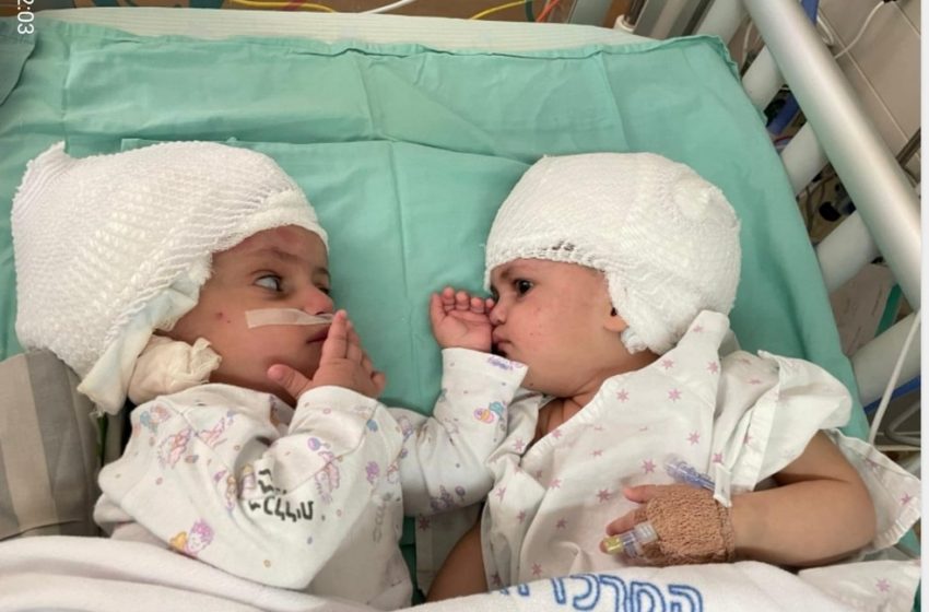  Gêmeas siamesas nascidas pela parte de trás da cabeça conseguem se ver após cirurgia