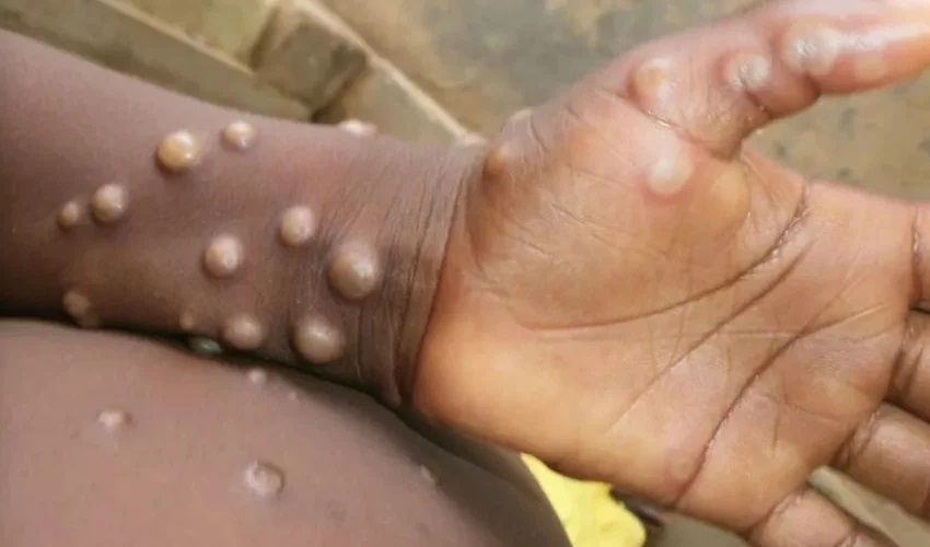  Brasil tem mais de 200 casos confirmados de varíola dos macacos