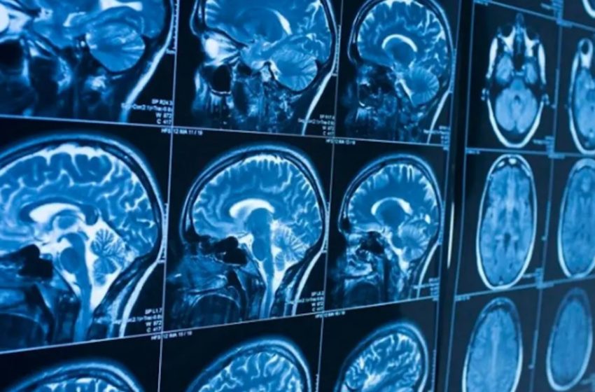  Hospitalização por Covid envelhece cérebro em até 20 anos, diz estudo