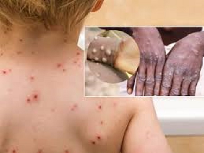  Paraná tem 10 casos confirmados de Monkeypox