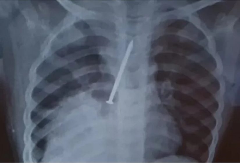  Menino de 3 anos morre após ficar um ano com prego no pulmão
