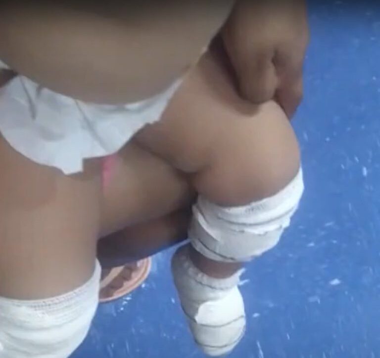  Bebê que teve queimaduras de sol em creche de Londrina recebe alta do hospital