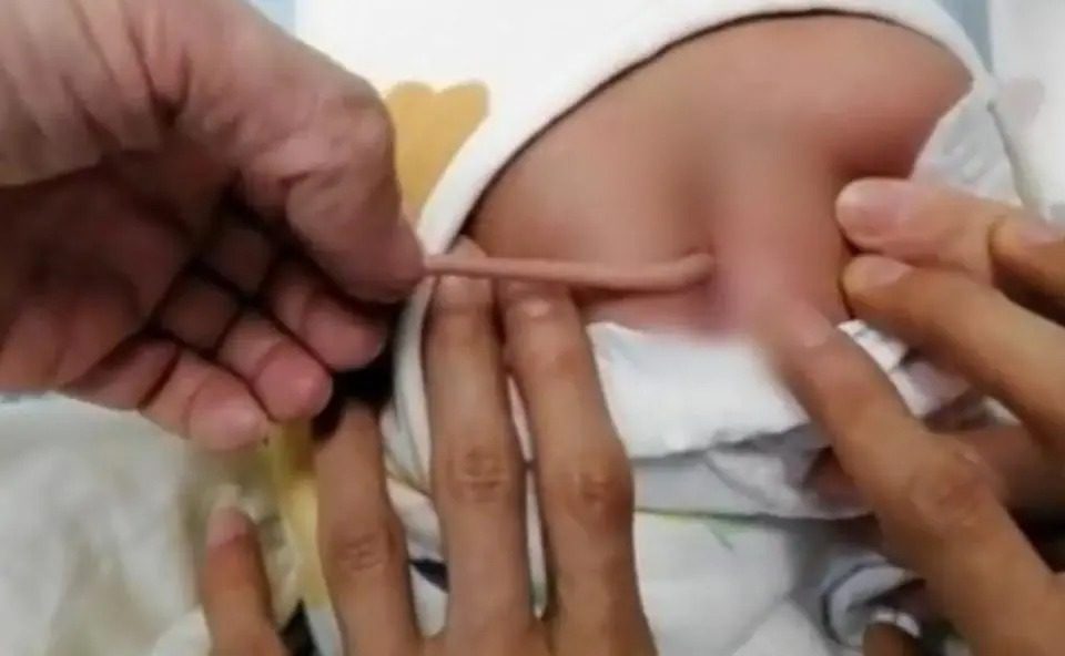  Bebê nasce com ‘cauda’ de 10 centímetros na China