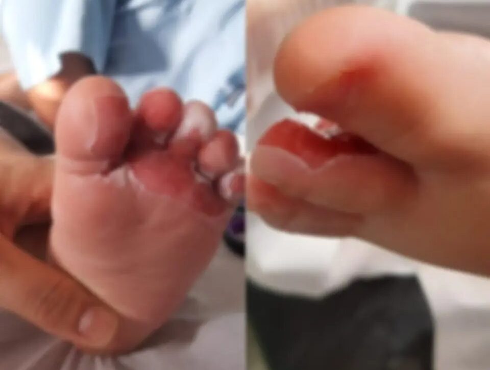  Bebê sofre queimaduras de 2º grau durante banho em creche de SC